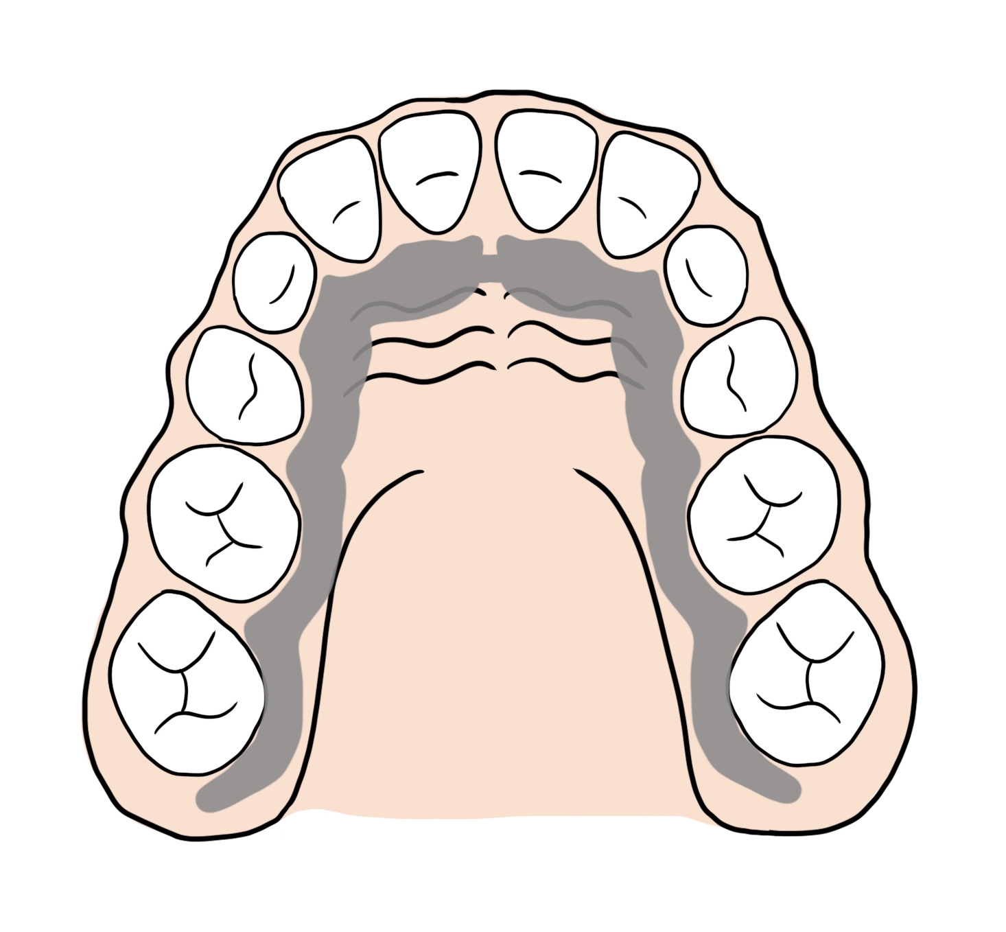 Plaque mandibulaire pour réaligner les dents